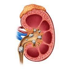 Application of potassium citrate in the treatment of kidney stones