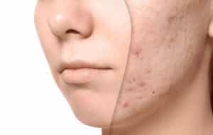 Use of citric acid to treat acne