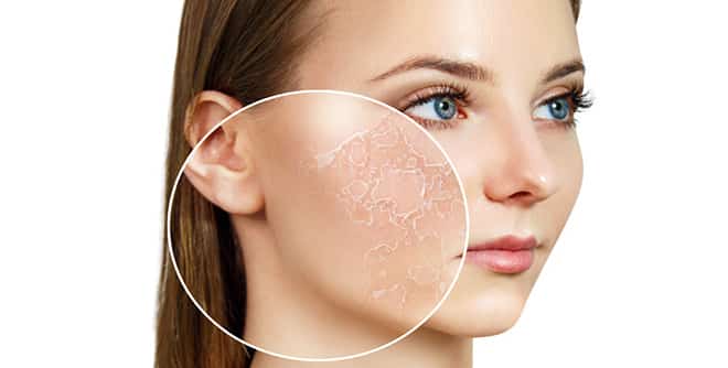 EDTA in the treatment of dry skin
